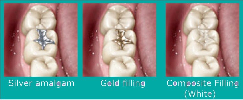 You are currently viewing The only way to fill a cavity is by using ‘silver fillings.’