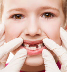 Read more about the article Permanent Tooth Knocked Out