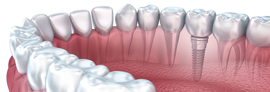 You are currently viewing Why Get Dental Implants ?