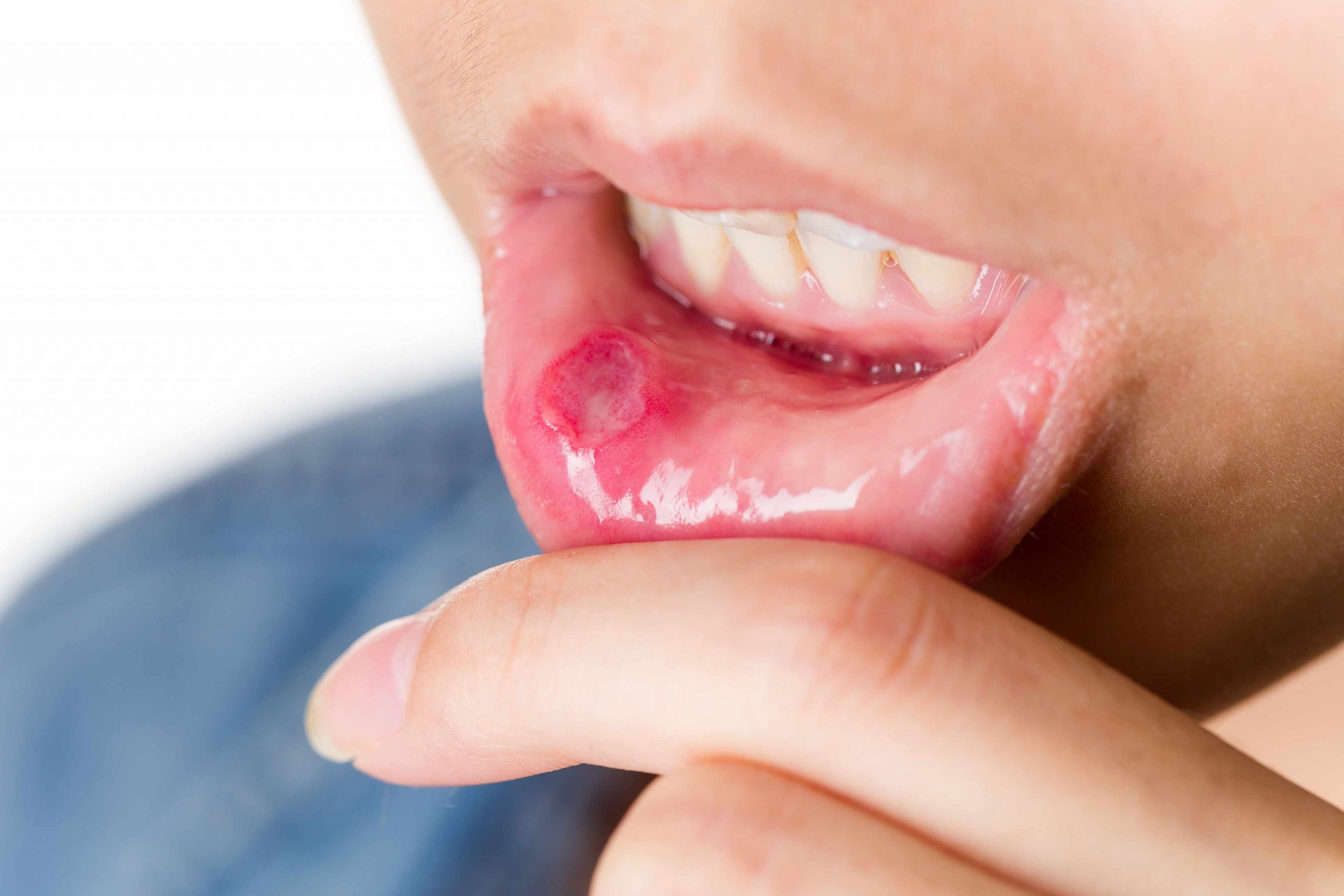 You are currently viewing Tips to Treat Mouth Sores (Canker or Aphthous Ulcer)