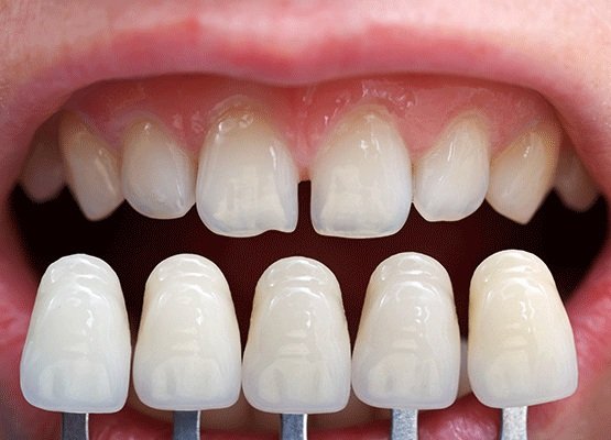 You are currently viewing Alternatives to Dental Veneers