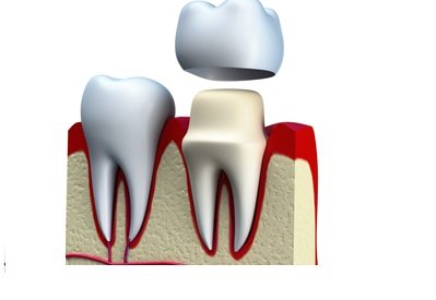 You are currently viewing Types of Dental Crowns