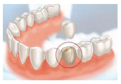 You are currently viewing How Long Do Dental Crowns Last?
