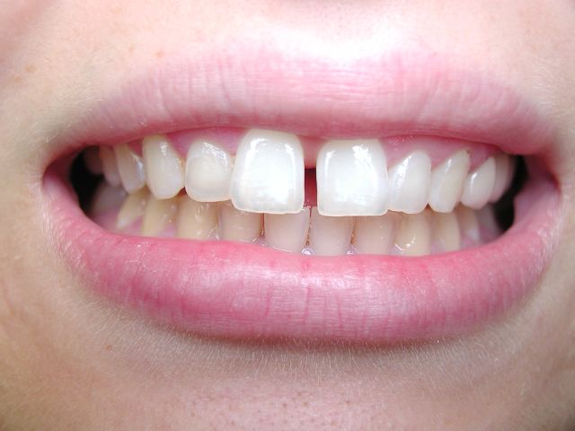 Read more about the article How to Fix Gap between Front Teeth?