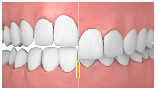 You are currently viewing What is Underbite, Overbite and Crossbite?