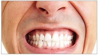 Read more about the article Prevent Teeth Grinding