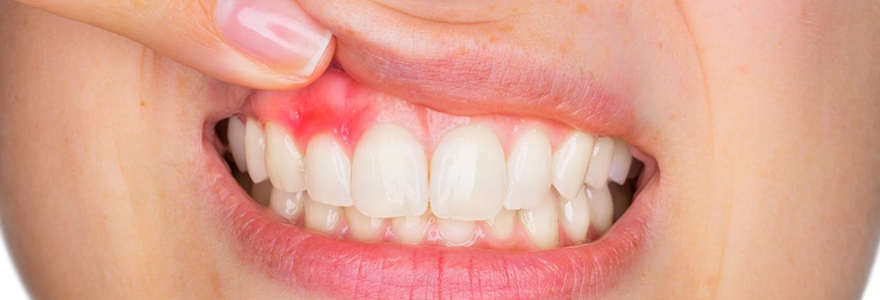 You are currently viewing Three Symptoms That You May Have Gingivitis
