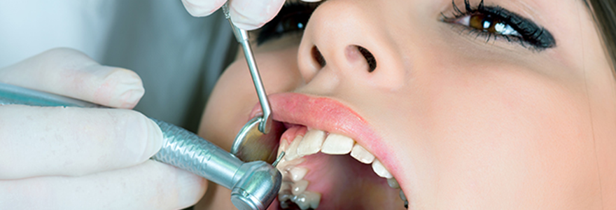 You are currently viewing How to Know You Need Dental Fillings?