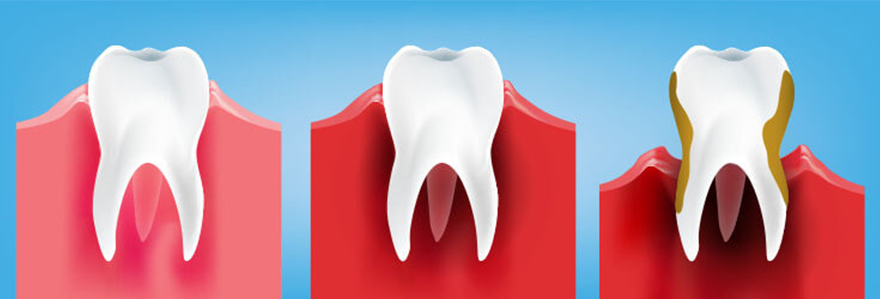 Read more about the article What is Gum Disease?