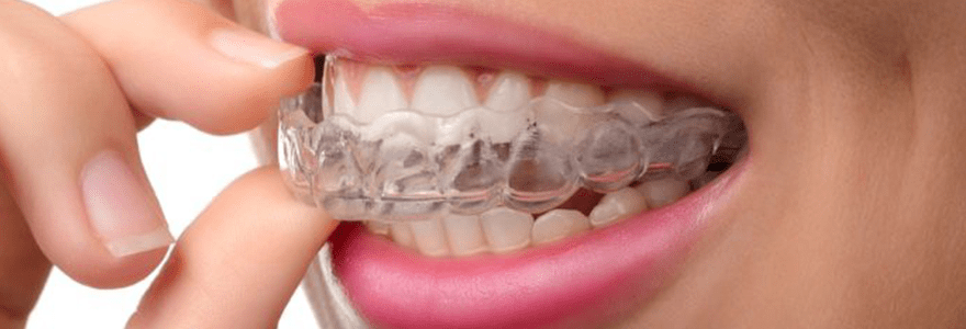 You are currently viewing Prevention of Injuries With Mouthguards