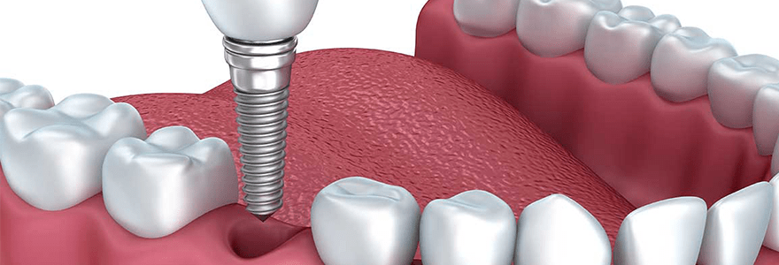 You are currently viewing Why Should You Get Dental Implants?