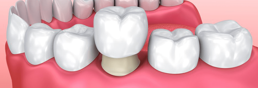 You are currently viewing Different Types of Dental Crowns