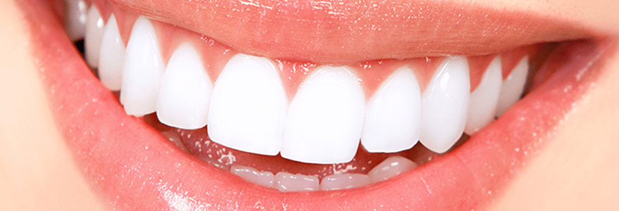 You are currently viewing Professional Teeth Whitening – Questions You Should Ask Your Dentist