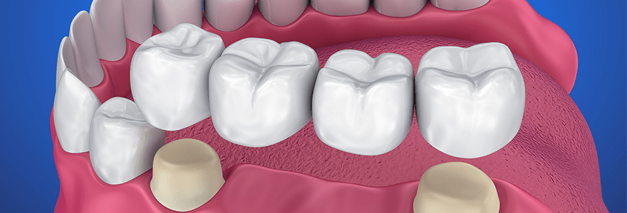 Read more about the article Replace Your Missing Tooth With Dental Crowns And Bridges