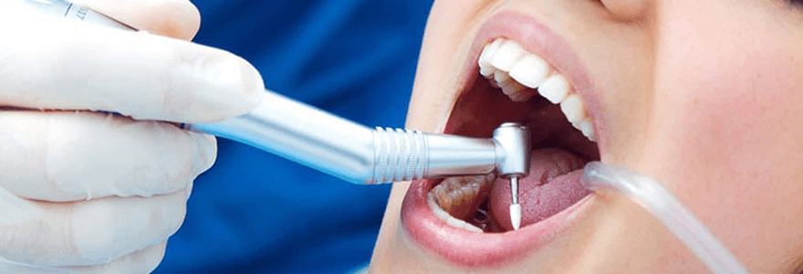 Read more about the article Visiting a Dentist If You Have a Broken Tooth