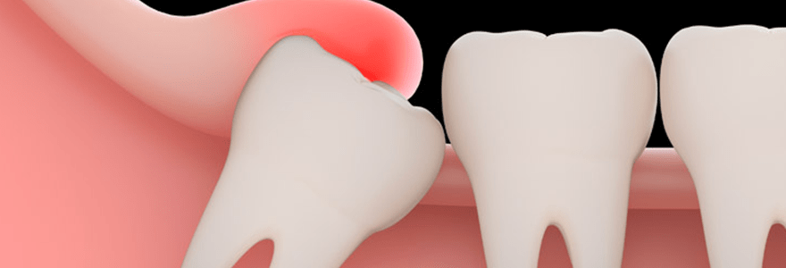 Read more about the article Why Wisdom Teeth Are Removed?