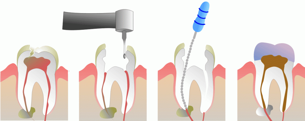 root-canal-procedure-image