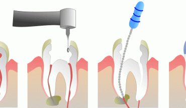 Read more about the article You Might Need a Root Canal if you Have One of These 7 Signs